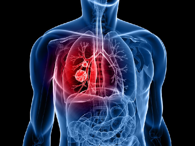 Une double immunothrapie sans chimiothrapie en premire ligne pour les CBNPC mtastatiques : les rsultats  4 ans de l'essai CheckMate 227