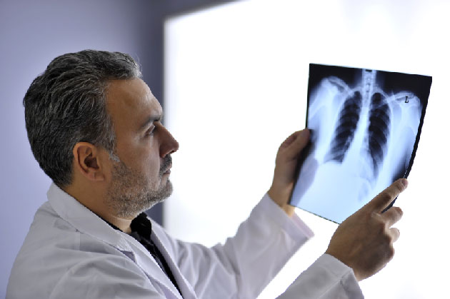 SMARCA4 et cancer du poumon non &agrave; petites cellules