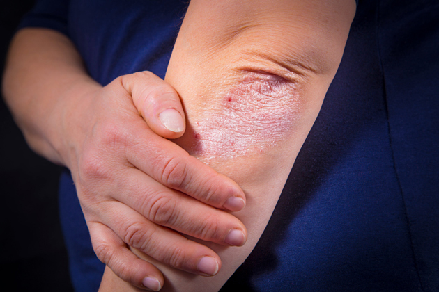 Le rhumatisme psoriasique et le psoriasis sont associs  un plus grand risque de fracture