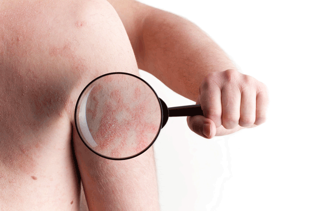 La rémission sous traitement pour le psoriasis est définie comme un IGA ou une surface cutanée atteinte à 0 pendant au moins 6 mois
