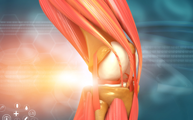 PRP et gonarthrose : un traitement qui ne peut tre recommand ?