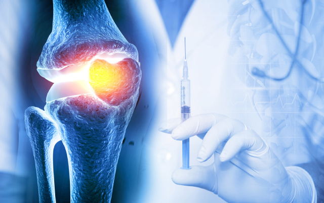 Efficacité des injections intra-articulaires de liposomes dans la gonarthrose : résultats d'un essai de phase 2