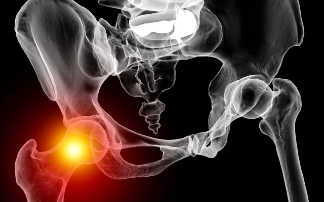 Comparaison du risque cardiovasculaire du romosozumab <i>vs</i> bisphosphonates au Japon