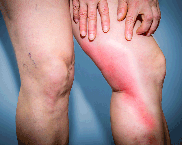 Polyarthrite rhumato&iuml;de et accidents veineux thrombotiques et embolie pulmonaire&nbsp;: quels risques en dehors des traitements&nbsp;?