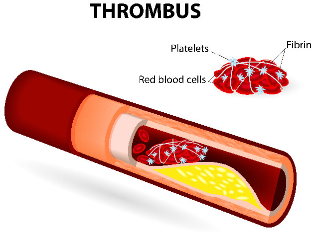 Les nouvelles g�n�rations d'inhibiteur de tyrosine kinase augmentent significativement le risque de thrombose art�rielle chez les patients atteints de LMC