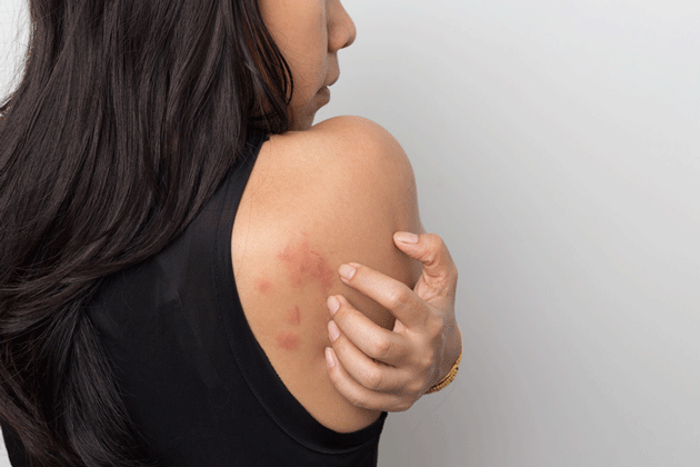 Barzolvolimab (anticorps anti-KIT) dans l'urticaire chronique spontanée : résultats prometteurs d'un essai de phase 1b
