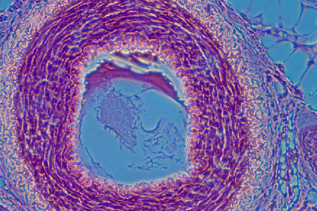 Polymorphisme de la rgion rgulatrice de TNFSF13B (BAFF) et rponse au rituximab dans les vascularites ANCA