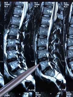 Un traitement séquentiel anti-ostéoporotique peut-il limiter le risque de nouvelles fractures vertébrales après cimentoplastie ?