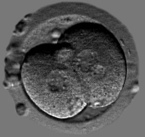 Fr�quence des embryons multinucl��s d�tect�s par un syst�me de time-lapse et son impact sur les issues de grossesses