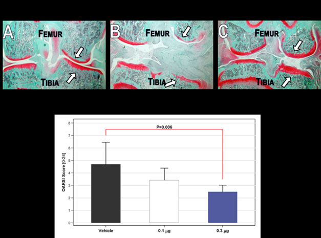 Le syst�me WNT et l'inhibition du syst�me WNT dans la gonarthrose&nbsp;: un  vrai espoir th�rapeutique