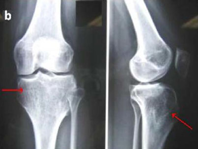 Complications articulaires des syndromes p�riodiques associ�s � la cryopyrine