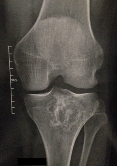 A la uneUne radiographie du genou anormale