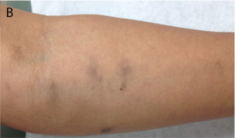 Attention, l'hydroxychloroquine peut pigmenter la peau