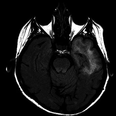 Leucoenc�phalopathie multifocale et Belimumab&nbsp;: une premi�re description