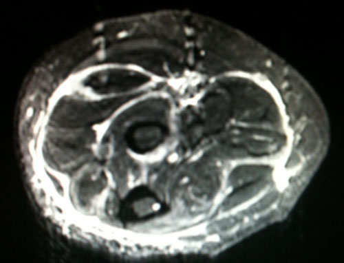 Des polyarthralgies associ�es � des myalgies