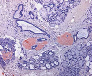 Biopsie de glandes salivaires accessoires et amylose