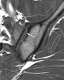 Un signal IRM anormal dans l�interligne sacro-iliaque&nbsp;: un nouveau signe diagnostique de spondyloarthrite&nbsp;?