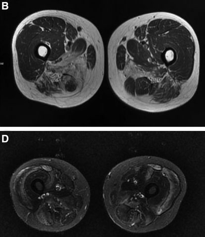 Int�r�t de l�IRM musculaire dans les myopathies n�crosantes avec anti-SRP