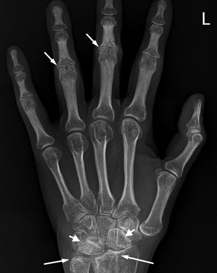 Syndrome BLAU&nbsp;: �tude transversale d�une cohorte de 31 patients
