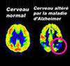 Nouveaux crit�res diagnostiques pour la maladie d�Alzheimer
