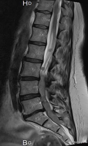 Quand la gravit� participe � la diffusion tumorale