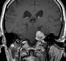 Schwannome vestibulaire