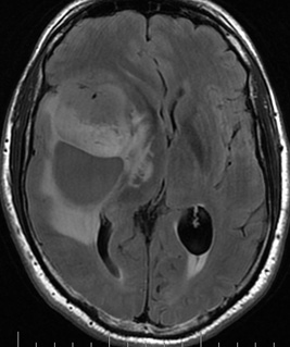 Les ventricules feutr�s