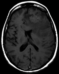 Entre circonvolutions et haustrations