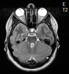 La rosette � deux compartiments