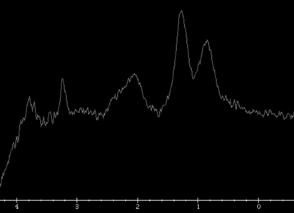 Une pr�sentation trompeuse d'une tumeur fr�quente