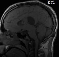 Une tumeur mise � sec