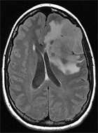 De l'intrt de la classification pronostique molculaire