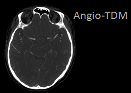 Une tumeur marquante