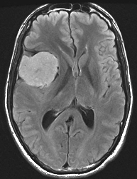 Les m�ninges tourment�es