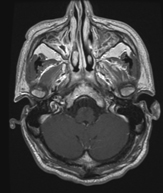 Inflammation ou pas&nbsp;?