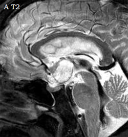 Une tumeur d�aspect chordo�de