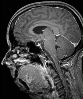 Plein les m�ninges