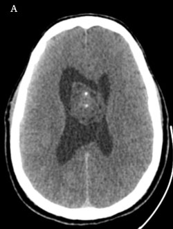 Une tumeur ventriculaire simulatrice