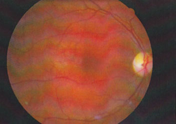 Diplopie et irritabilit�