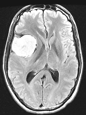 Les m�ninges trompeuses