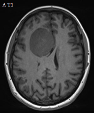 Du gras dans la t�te