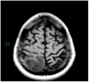 La tumeur qui venait du chat