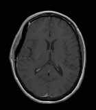 Un m�ningiome bien trop agressif�