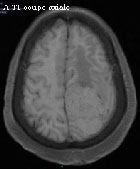 Une tumeur simulant un m�ningiome