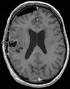 Une pastille � faire fondre dans la t�te&nbsp;: deux cas cliniques