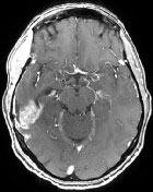 Une pastille � faire fondre dans la t�te&nbsp;: deux cas cliniques