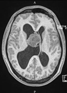 Une tumeur c�r�brale � d�crypter