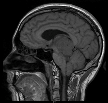 C�phal�es, perte de poids chez un jeune adulte