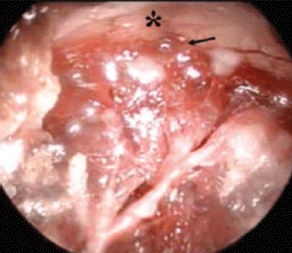 A cheval sur le Chiasma