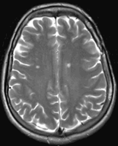 R�action aigu� et inhabituelle � l'irradiation enc�phalique